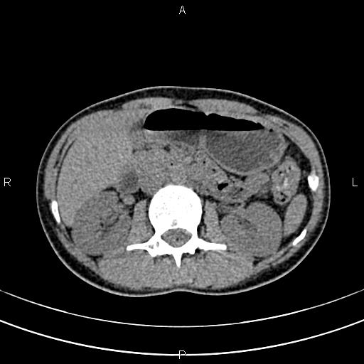 File:Calcified hepatic hydatid cyst (Radiopaedia 83870-99072 Axial non-contrast 69).jpg