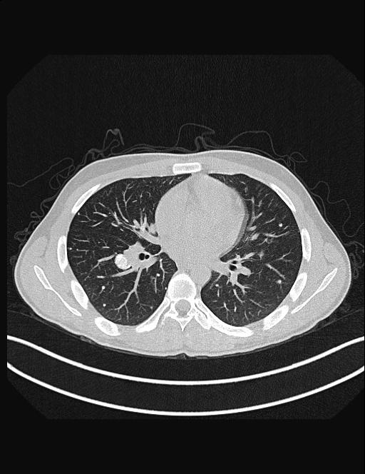 Calcifying pulmonary metastases (Radiopaedia 33359-34396 Axial lung window 34).jpg