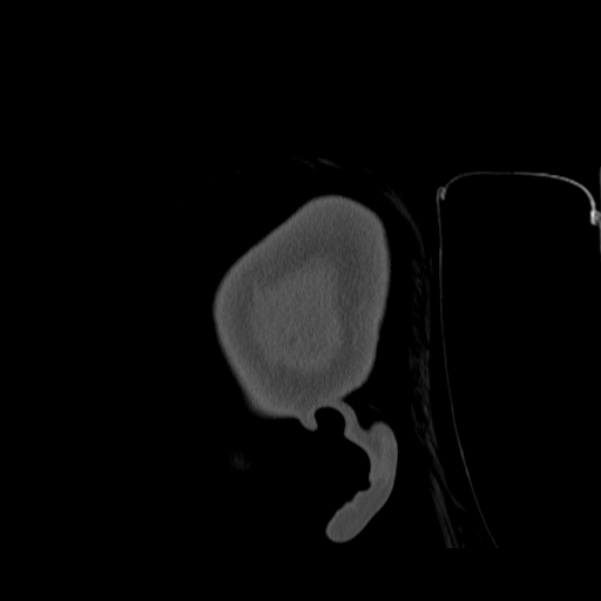 Calvarial osteoma (Radiopaedia 36520-38079 Sagittal bone window 107).jpg