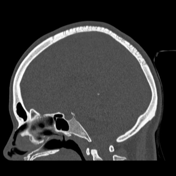 Calvarial osteoma (Radiopaedia 36520-38079 Sagittal bone window 57).jpg