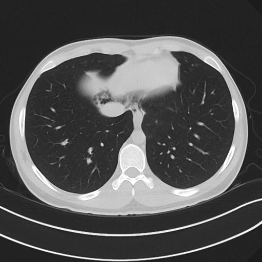 Cannabis ('bong') smoking induced pneumomediastinum and subcutaneous emphysema (Radiopaedia 29947-30479 C 60).jpg