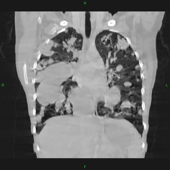 File:Cannon ball metastases - synovial sarcoma (Radiopaedia 26135-26271 Coronal lung window 8).jpg