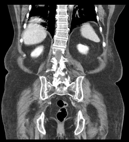 Cannonball metastases from endometrial cancer (Radiopaedia 42003-45031 F 49).png