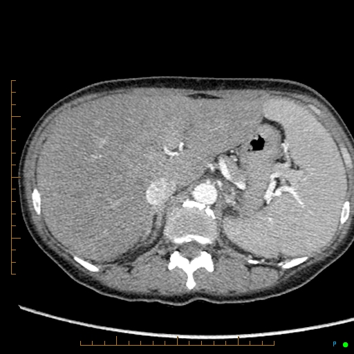 Canonball lung metastasis (Radiopaedia 77634-89837 B 105).jpg