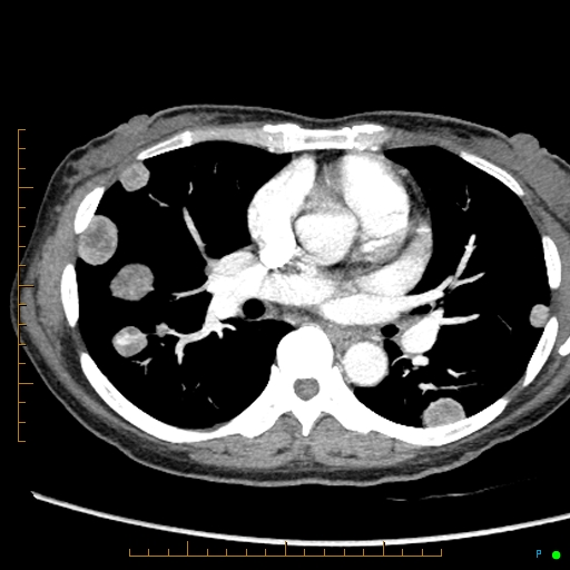 Canonball lung metastasis (Radiopaedia 77634-89837 B 48).jpg