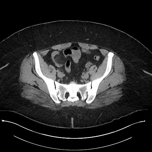 Carcinoid tumor - terminal ileum (Radiopaedia 60931-68740 Axial non-contrast 93).jpg