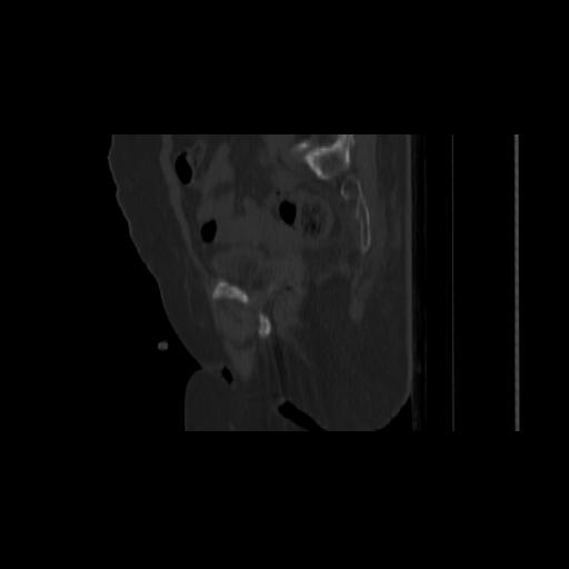 Carcinoma cervix- brachytherapy applicator (Radiopaedia 33135-34173 Sagittal bone window 64).jpg