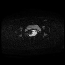 Carcinoma of the cervix (Radiopaedia 89018-105858 Axial DWI 52).jpg