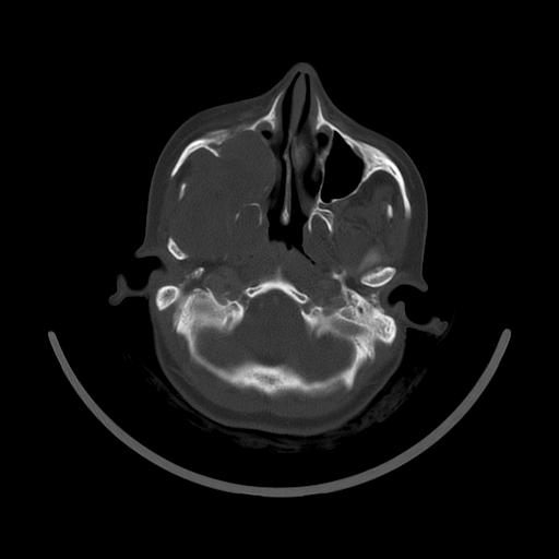 Carcinoma of the maxillary antrum (Radiopaedia 53805-59888 Axial bone window 48).jpg