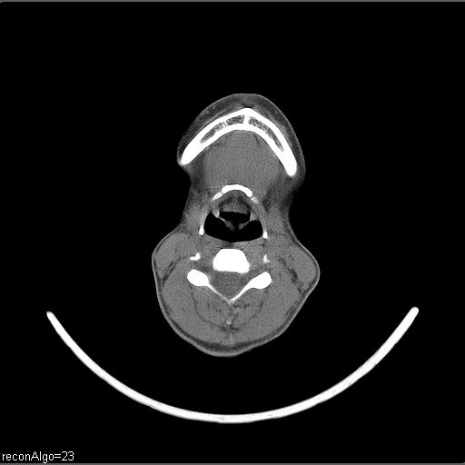 Carcinoma of the maxillary antrum (Radiopaedia 53805-59888 Axial non-contrast 32).jpg