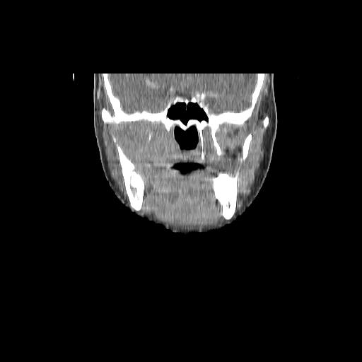 File:Carcinoma of the maxillary antrum (Radiopaedia 53805-59888 Coronal C+ delayed 65).jpg