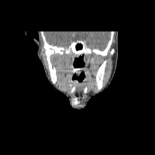 Carcinoma of the maxillary antrum (Radiopaedia 53805-59888 Coronal C+ delayed 78).jpg