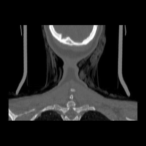 Carcinoma of the maxillary antrum (Radiopaedia 53805-59888 Coronal bone window 147).jpg