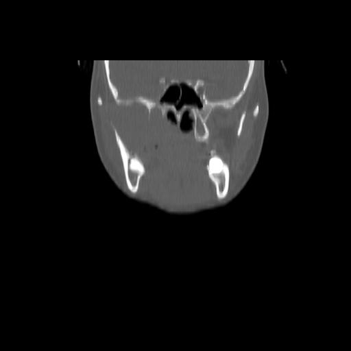 Carcinoma of the maxillary antrum (Radiopaedia 53805-59888 Coronal bone window 58).jpg