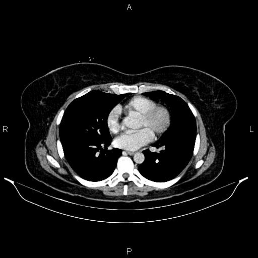 Carcinoma of uterine cervix (Radiopaedia 85861-101700 A 22).jpg