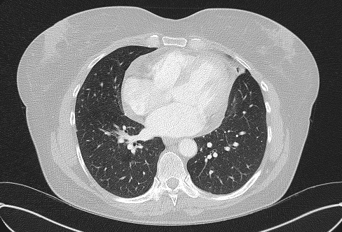 Cardiac sarcoidosis (Radiopaedia 74548-85534 Axial lung window 55).jpg