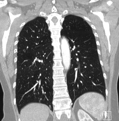 Cardiac sarcoidosis (Radiopaedia 74548-85534 Coronal lung window 49).jpg