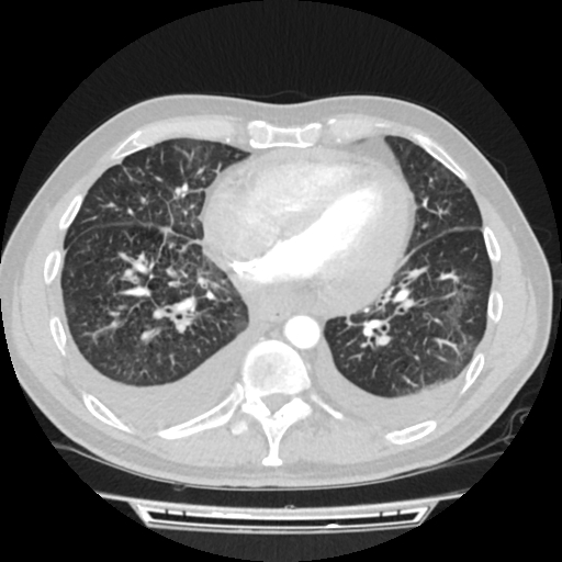 File:Cardiac tamponade (Radiopaedia 78607-91368 Axial lung window 58).jpg