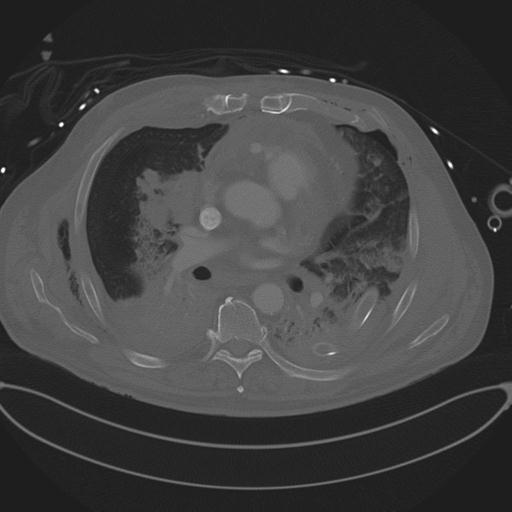 Cardiac trauma (Radiopaedia 32874-33858 Axial bone window 46).jpg