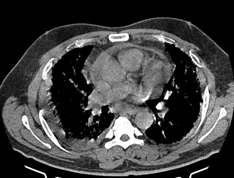 Cardiogenic pulmonary edema (Radiopaedia 68180-77678 Axial non-contrast 24).jpg
