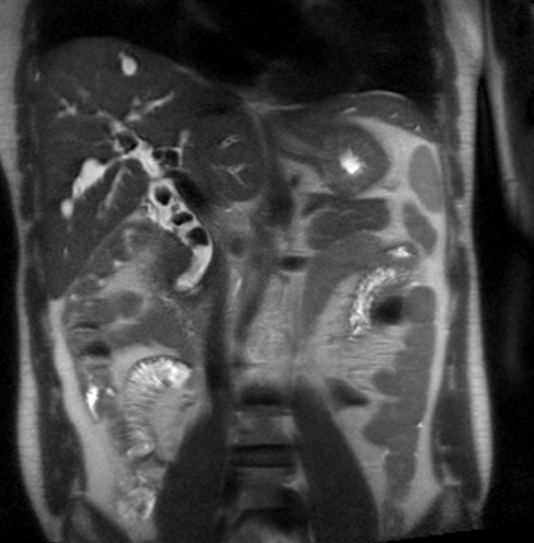 File:Caroli disease with medullary sponge kidney and nephrocalcinosis (Radiopaedia 10805-11251 Coronal T2 1).jpg