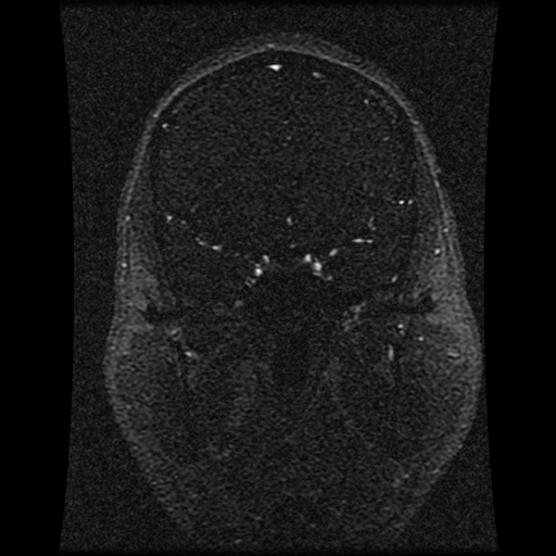Carotid arterial dissection with acute cerebral infarction (Radiopaedia 26636-26784 MRV 111).jpg