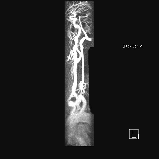 File:Carotid artery dissection (Radiopaedia 28441-28689 MIP Carotids MRA 2).jpg