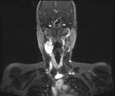 Carotid body tumor (Radiopaedia 12777-12912 MRA 29).jpg