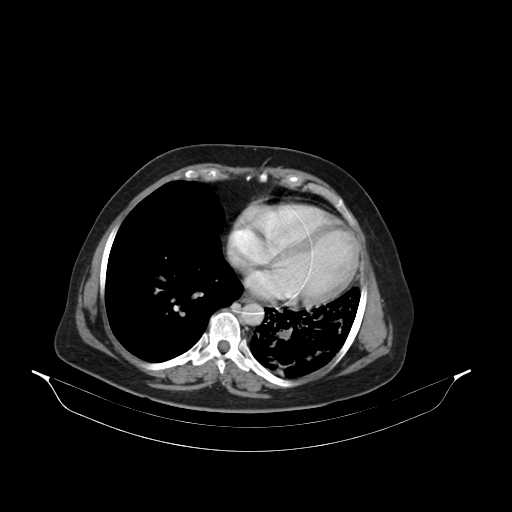 File:Carotid body tumor (Radiopaedia 21021-20948 B 48).jpg