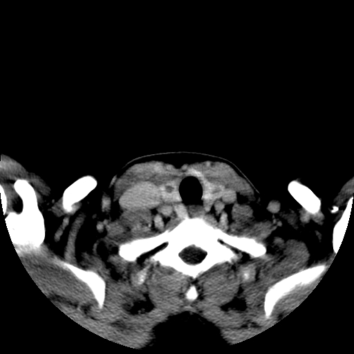 File:Carotid body tumor (Radiopaedia 27890-28124 A 25).jpg