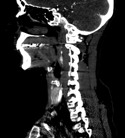 File:Carotid body tumor (Radiopaedia 39845-42300 D 63).jpg