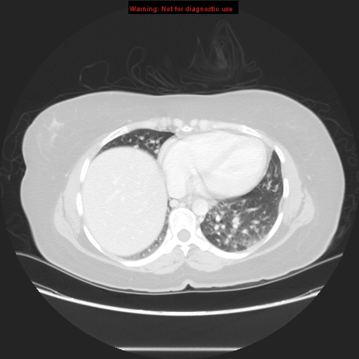 File:Carotid body tumor with lung metastases (Radiopaedia 9301-48390 Axial lung window 50).jpg