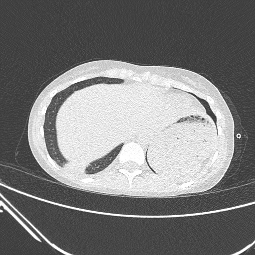 Catamenial pneumothorax (Radiopaedia 27946-28197 lung window 136).jpg