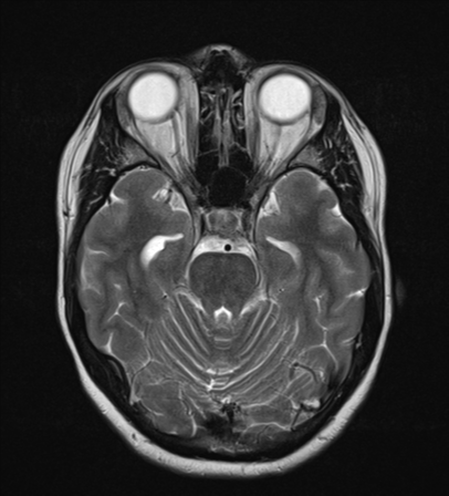 File:Cavernoma with bleed - midbrain (Radiopaedia 54546-60774 Axial T2 9).png