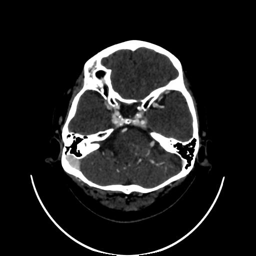 Cavernoma with developmental venous anomaly (Radiopaedia 22470-22506 C 31).jpg