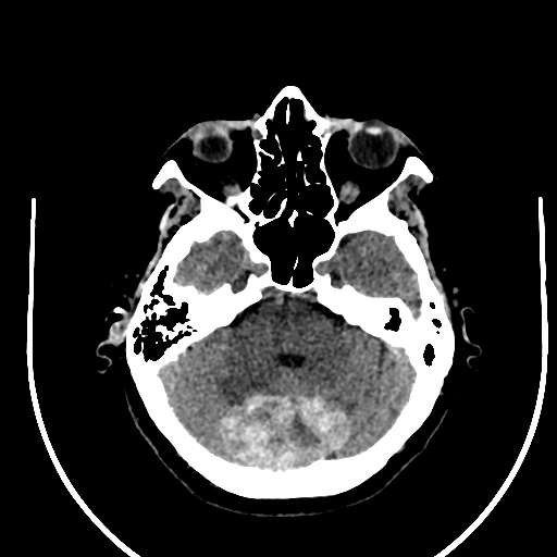 Cavernous hemangioma of the cerebellar falx (Radiopaedia 73025-83723 Axial non-contrast 37).jpg