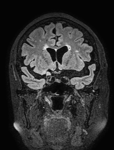 Cavernous hemangioma of the cerebellar falx (Radiopaedia 73025-83724 Coronal FLAIR 128).jpg