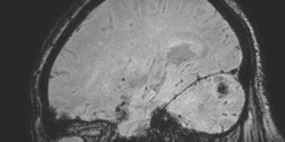 Cavernous hemangioma of the cerebellar falx (Radiopaedia 73025-83724 Sagittal BOLD 143).jpg