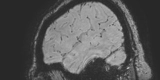 File:Cavernous hemangioma of the cerebellar falx (Radiopaedia 73025-83724 Sagittal BOLD 30).jpg