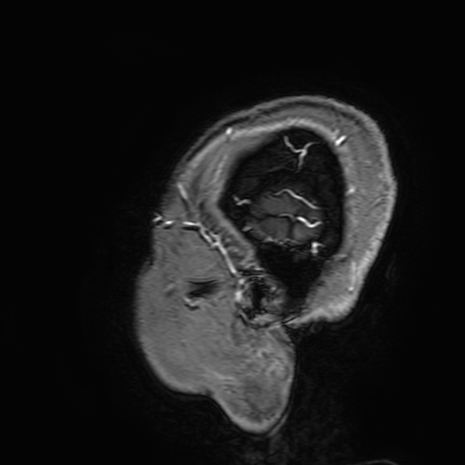 Cavernous hemangioma of the cerebellar falx (Radiopaedia 73025-83724 Sagittal T1 C+ 200).jpg