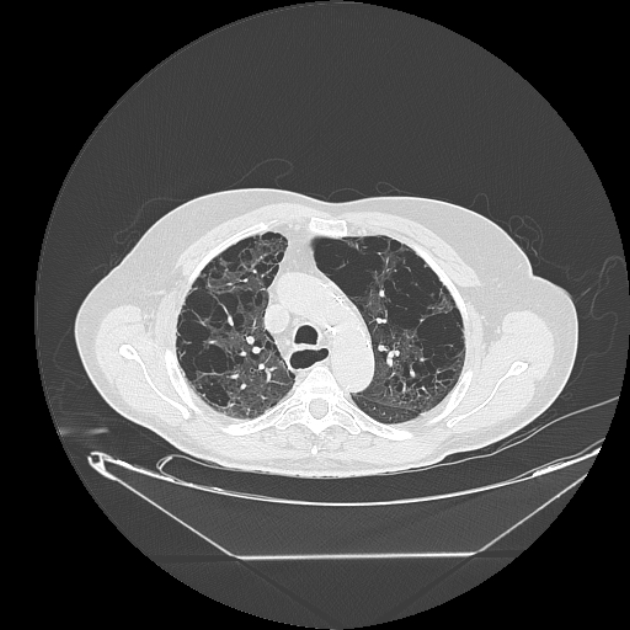 Cavitating bronchogenic carcinoma (Radiopaedia 44489-48162 Axial lung window 23).jpg