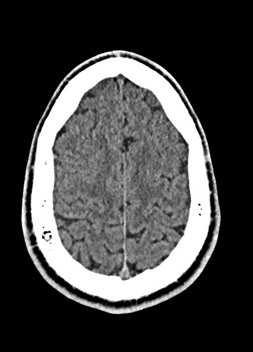 Cavum septum pellucidum and cavum vergae (Radiopaedia 77797-90060 Axial Brain Window 85).jpg