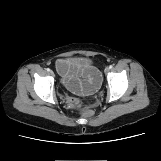 Cecal adenocarcinoma (Radiopaedia 75909-87331 A 79).jpg