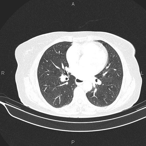 Cecal cancer (Radiopaedia 85610-101358 Axial lung window 36).jpg