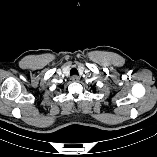 File:Cecal cancer with appendiceal mucocele (Radiopaedia 91080-108651 A 8).jpg