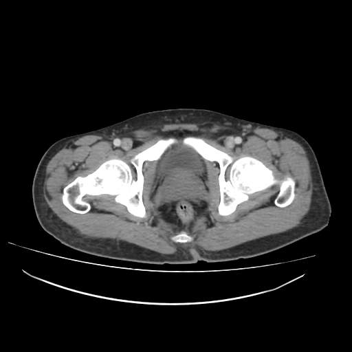 File:Cecal carcinoma with local lymphadenopathy (Radiopaedia 31428-32240 A 53).jpg