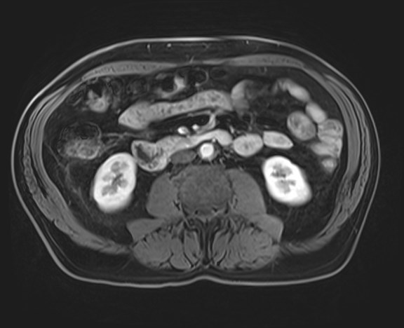 Cecal mass causing appendicitis (Radiopaedia 59207-66532 H 72).jpg