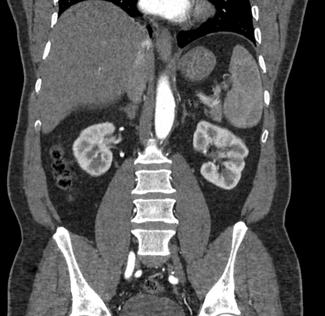 Celiac artery dissection (Radiopaedia 52194-58080 C 84).jpg