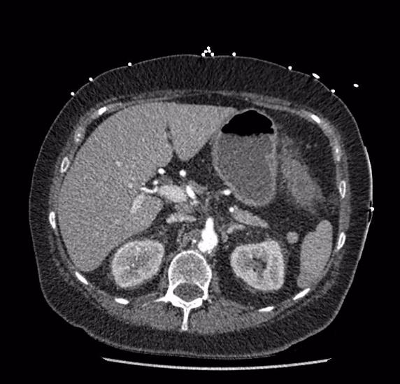 Celiac artery severe stenosis and dissection (Radiopaedia 44128-47842 B 26).jpg