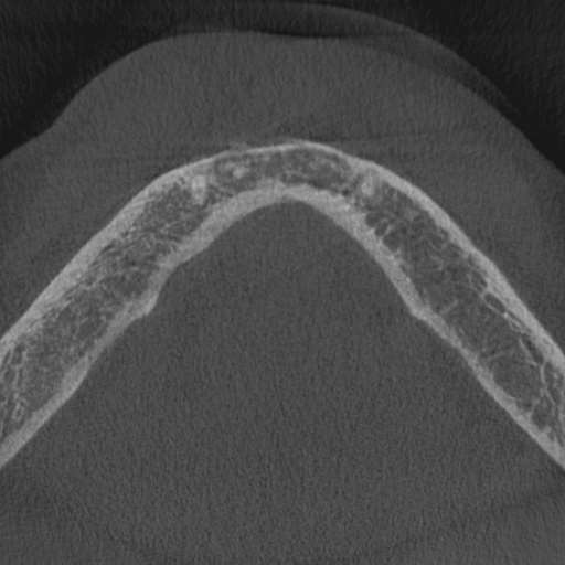 Cemento-osseous dysplasia (Radiopaedia 48251-53126 Axial non-contrast 15).jpg